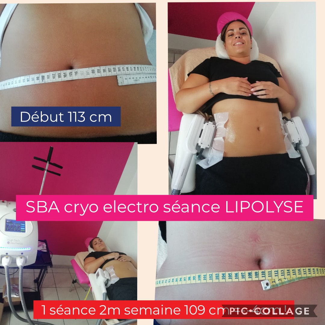 SBA  cryo lipolyse amincissement mincir minceur cellulite