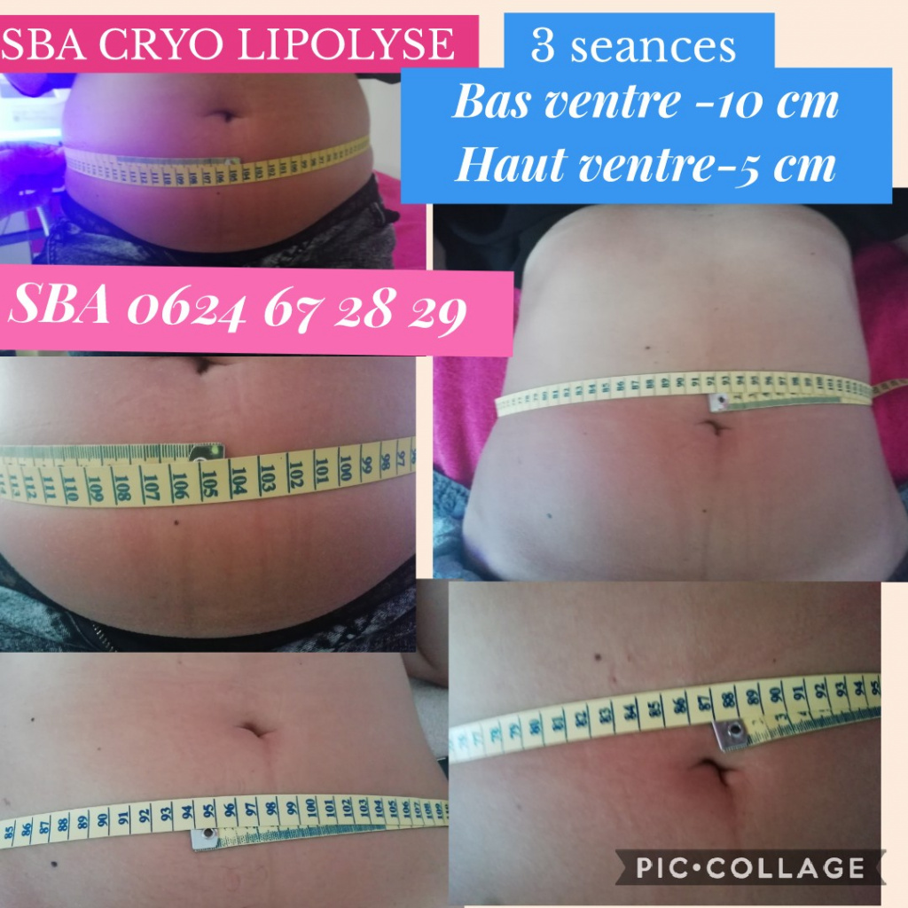 SBA cryolipolyse coolsculpting cellulite